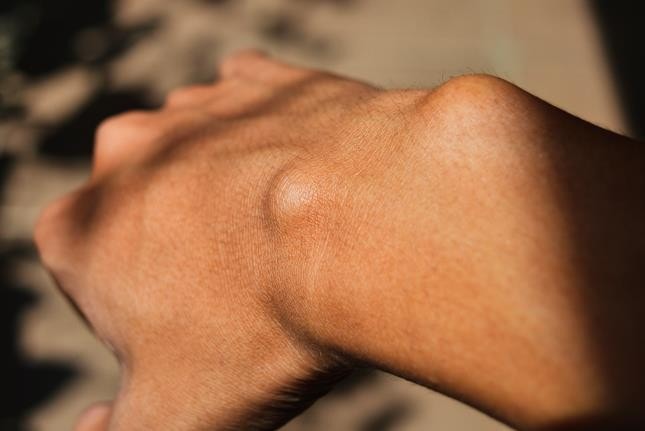 Close-up da mão e pulso, mostrando um nódulo visível sob a pele, indicando um lipoma ou tumor benigno