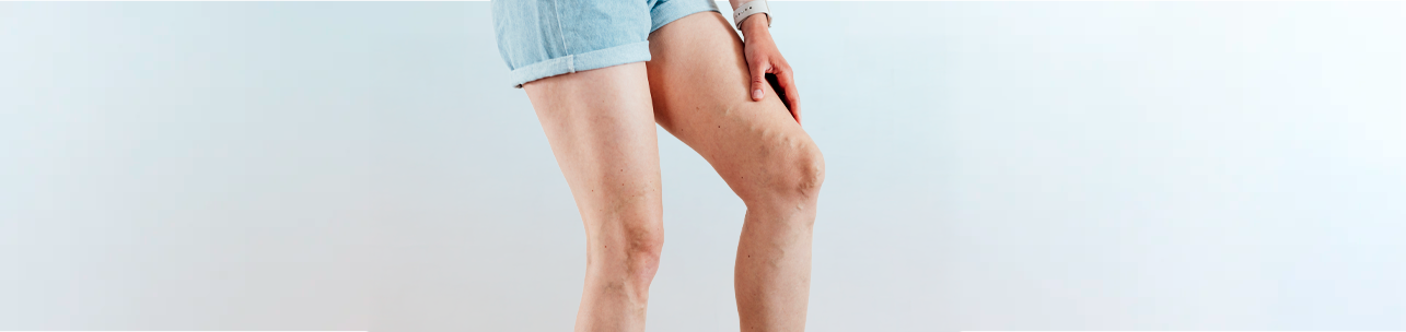 Uma visão em close-up das pernas de uma pessoa que está vestindo shorts jeans, mostrando veias varicosas proeminentes e vasinhos